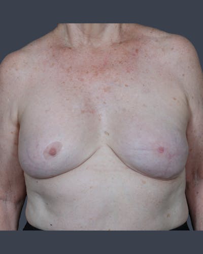 Implant Breast Reconstruction Before & After Gallery - Patient 153195 - Image 1