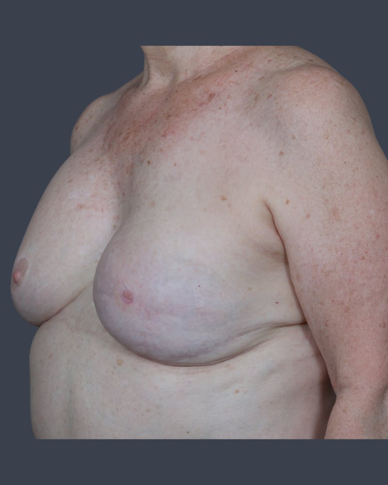 Implant Breast Reconstruction Before & After Gallery - Patient 153195 - Image 3