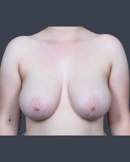 Before procedure image for Breast Reduction