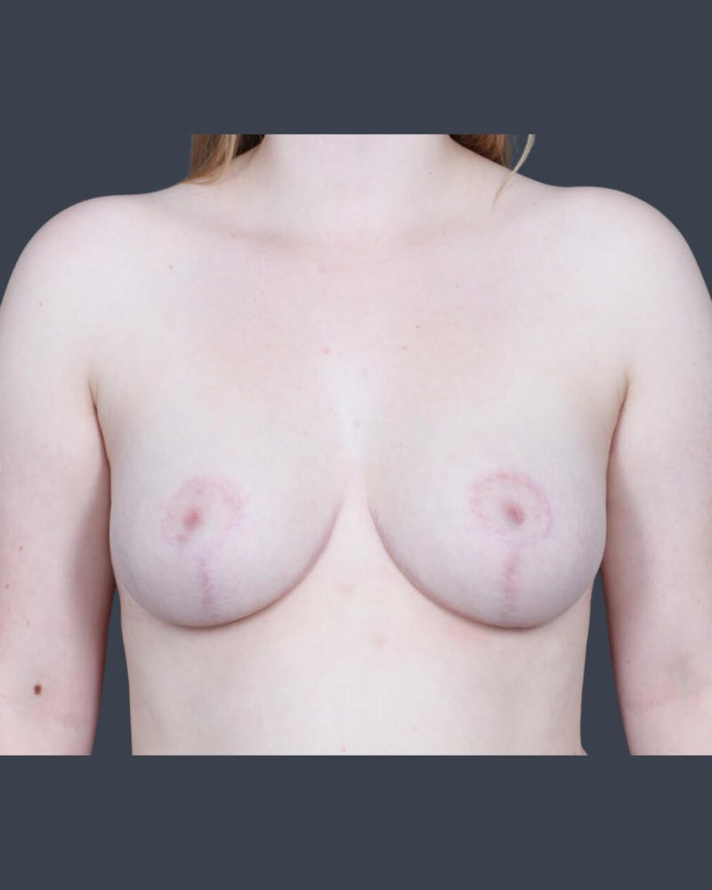 Breast Reduction Before & After Gallery - Patient 178076 - Image 2