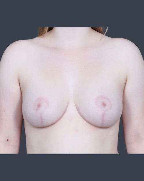 After procedure image for Breast Reduction