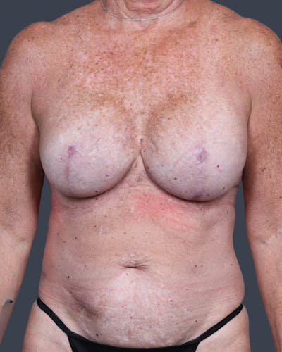 DIEP Flap Before & After Gallery - Patient 537536 - Image 1