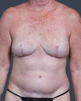 DIEP Flap Before & After Gallery - Patient 537536 - Image 2