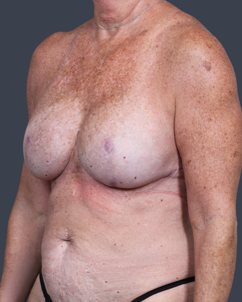 DIEP Flap Before & After Gallery - Patient 537536 - Image 3