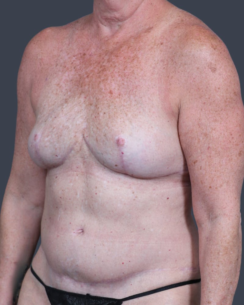 DIEP Flap Before & After Gallery - Patient 537536 - Image 4