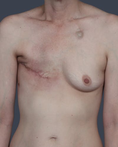 DIEP Flap Before & After Gallery - Patient 324554 - Image 1