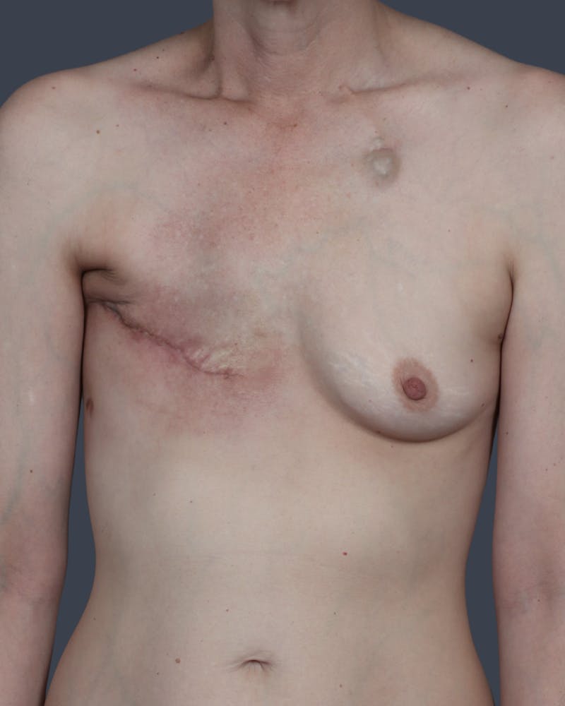 DIEP Flap Before & After Gallery - Patient 324554 - Image 1