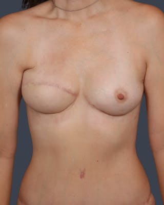DIEP Flap Before & After Gallery - Patient 324554 - Image 2