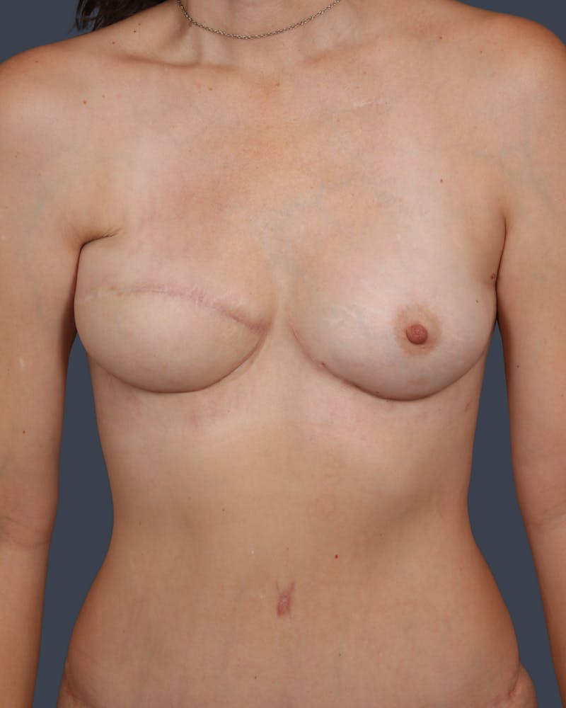 DIEP Flap Before & After Gallery - Patient 324554 - Image 2