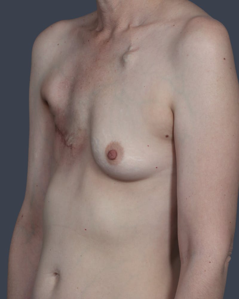 DIEP Flap Before & After Gallery - Patient 324554 - Image 3