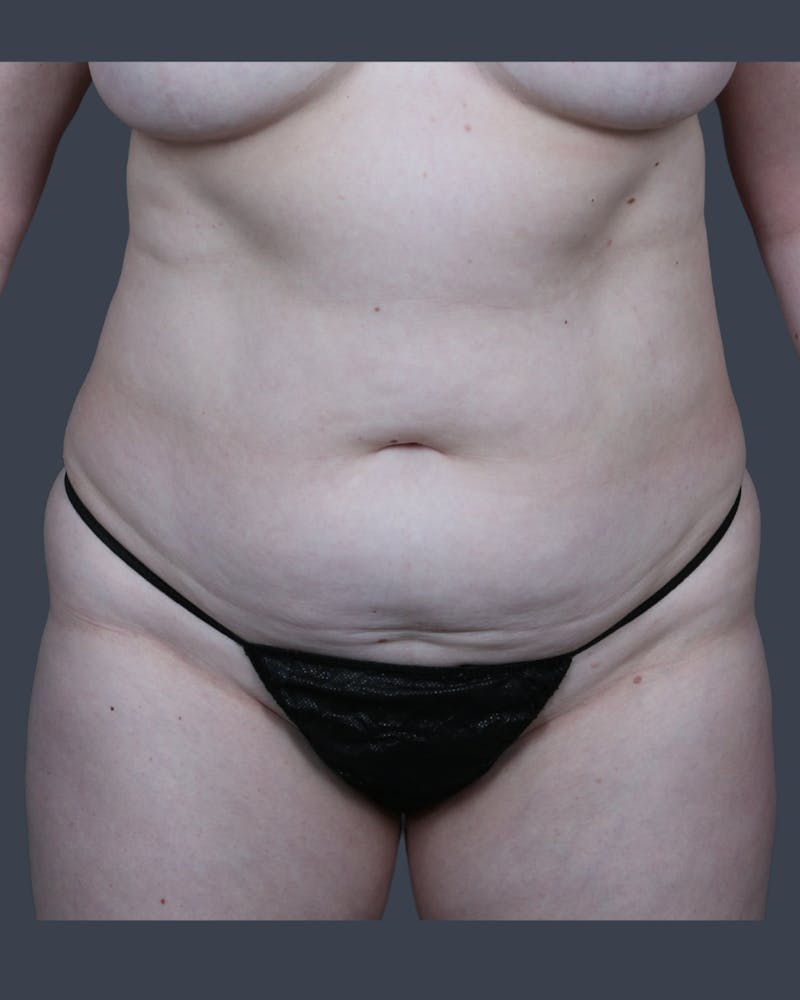 Abdominoplasty / Tummy Tuck Before & After Gallery - Patient 410488 - Image 1