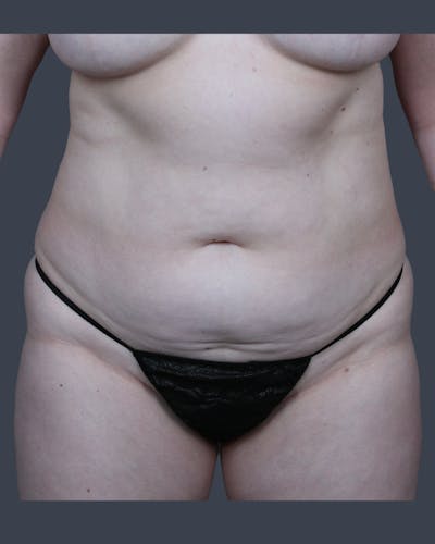 Abdominoplasty / Tummy Tuck Before & After Gallery - Patient 410488 - Image 1