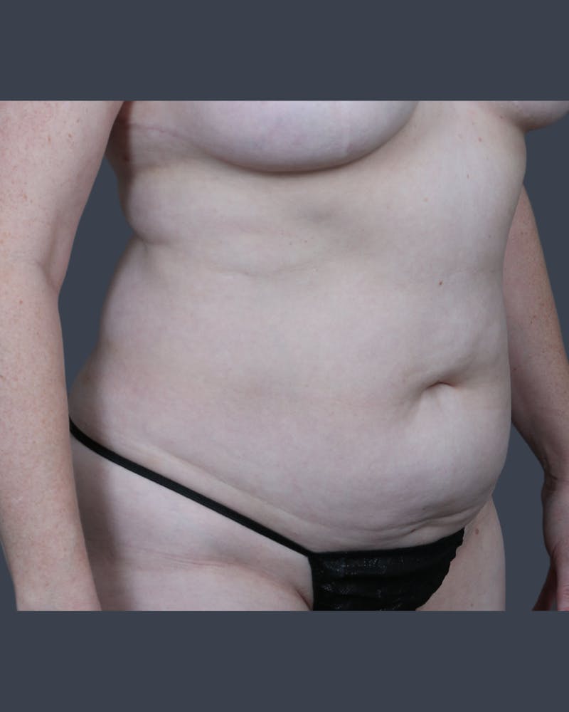 Abdominoplasty / Tummy Tuck Before & After Gallery - Patient 410488 - Image 3