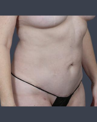 Abdominoplasty / Tummy Tuck Before & After Gallery - Patient 410488 - Image 4