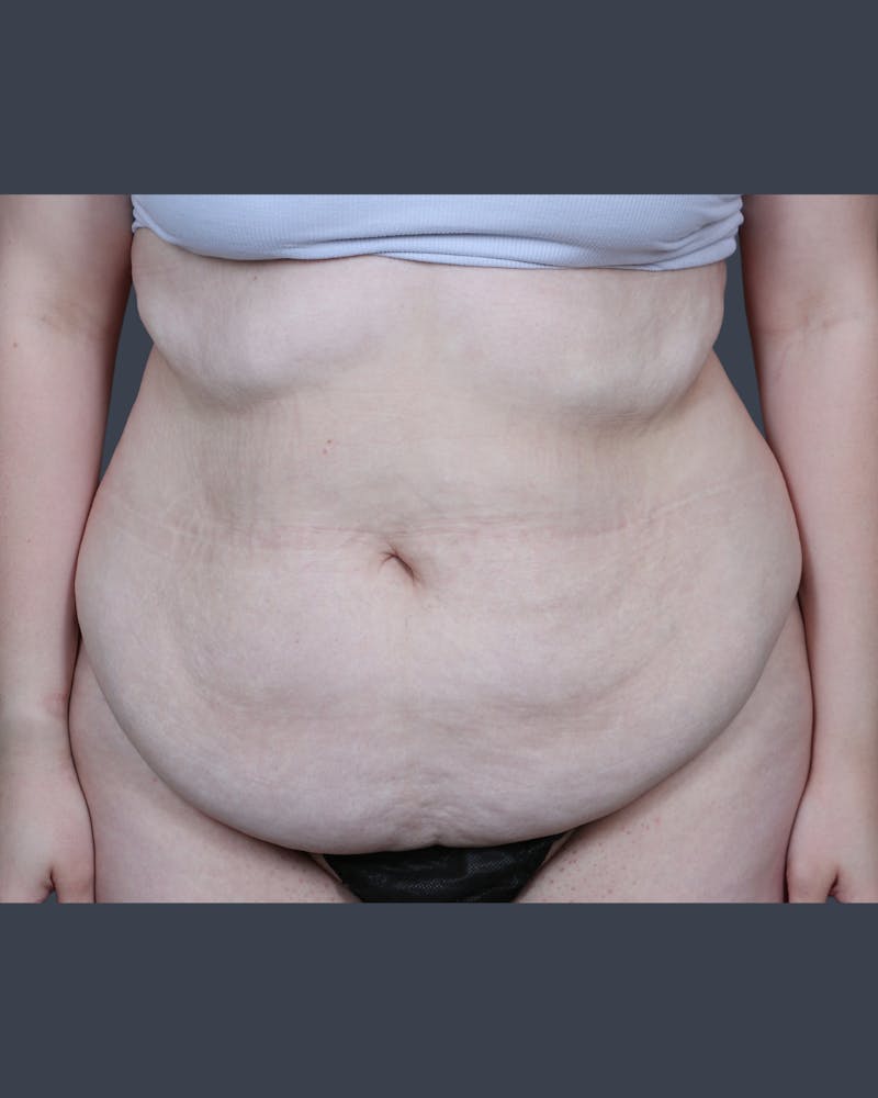 Abdominoplasty / Tummy Tuck Before & After Gallery - Patient 321514 - Image 1