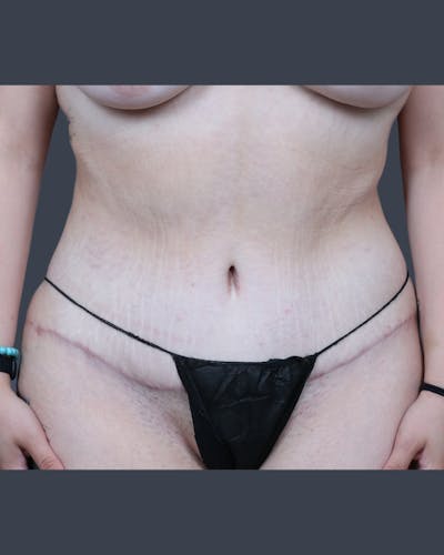 Abdominoplasty / Tummy Tuck Before & After Gallery - Patient 321514 - Image 2