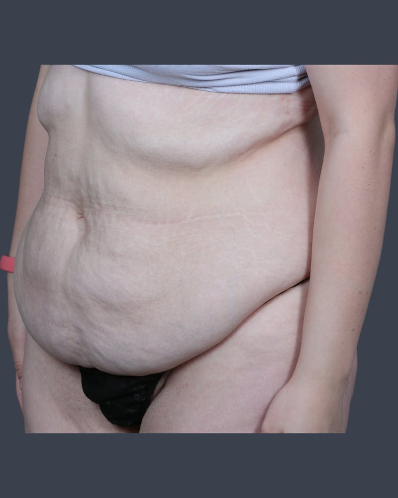 Abdominoplasty / Tummy Tuck Before & After Gallery - Patient 321514 - Image 3
