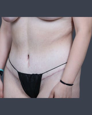Abdominoplasty / Tummy Tuck Before & After Gallery - Patient 321514 - Image 4