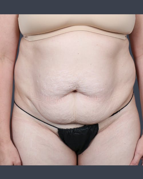 Before procedure image for Abdominoplasty / Tummy Tuck