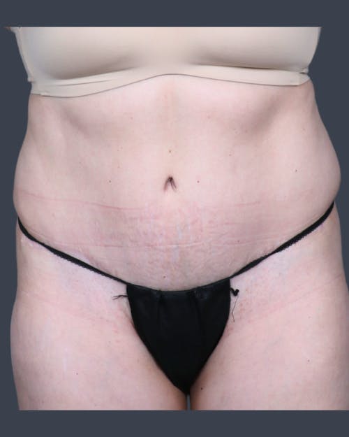 After procedure image for Abdominoplasty / Tummy Tuck