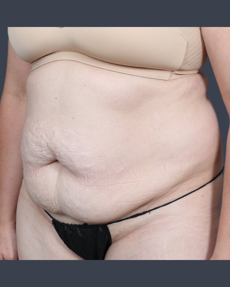 Abdominoplasty / Tummy Tuck Before & After Gallery - Patient 132522 - Image 3