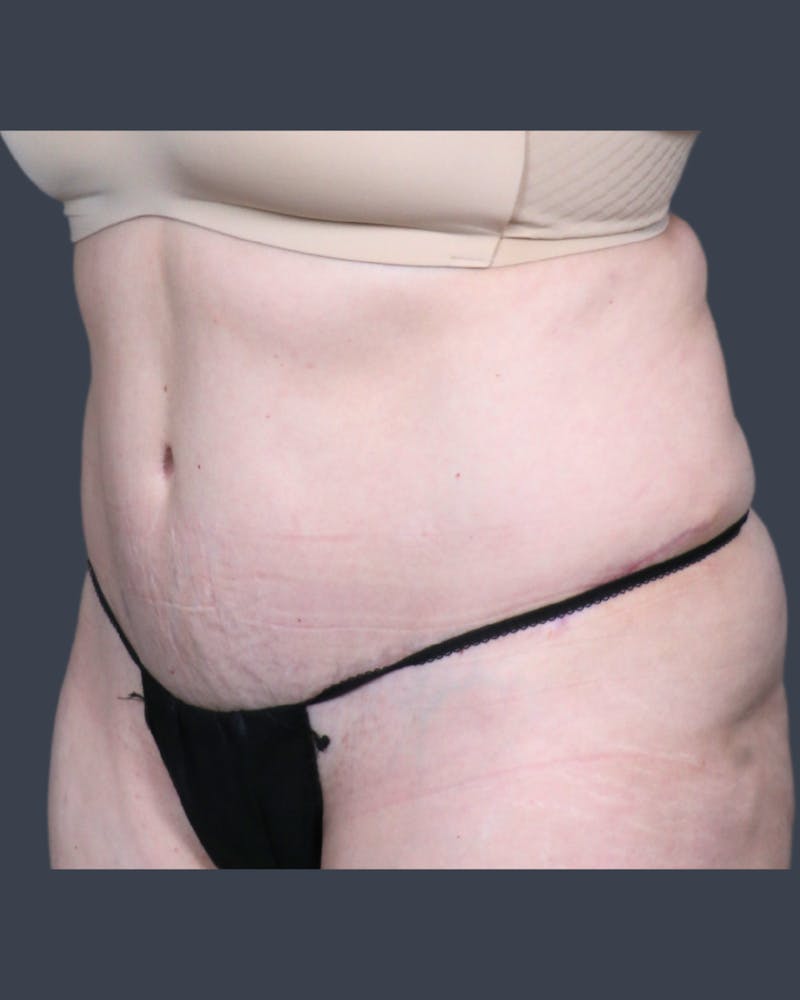 Abdominoplasty / Tummy Tuck Before & After Gallery - Patient 132522 - Image 4