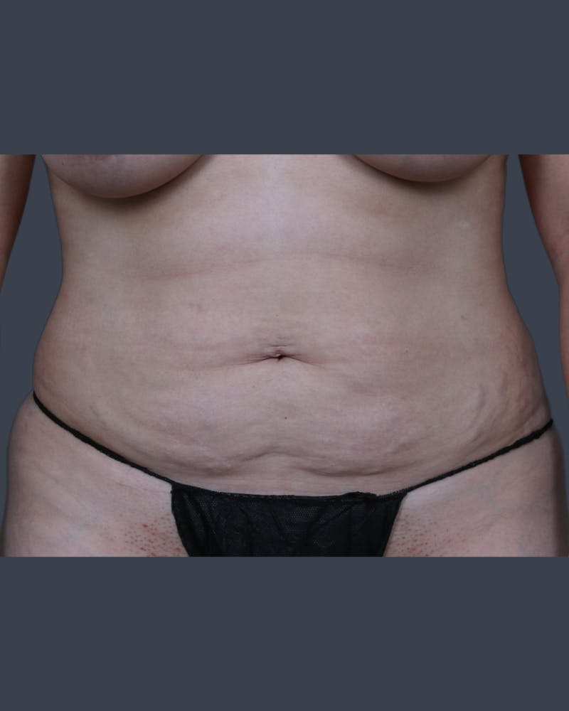 Liposuction Before & After Gallery - Patient 344436 - Image 1