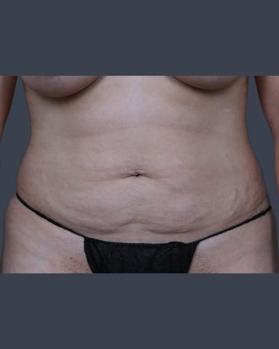 Liposuction Before & After Gallery - Patient 344436 - Image 1