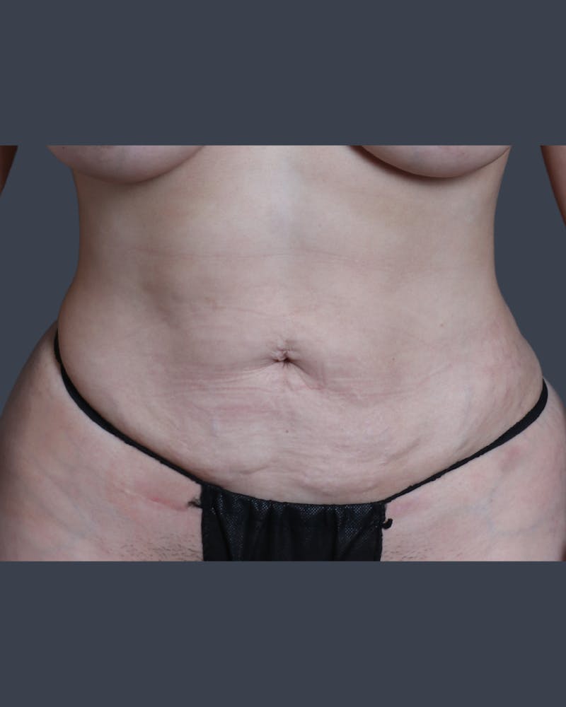 Liposuction Before & After Gallery - Patient 344436 - Image 2