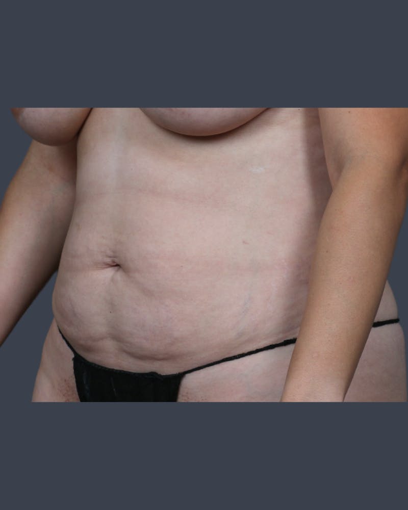Liposuction Before & After Gallery - Patient 344436 - Image 3