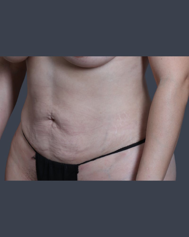 Liposuction Before & After Gallery - Patient 344436 - Image 4