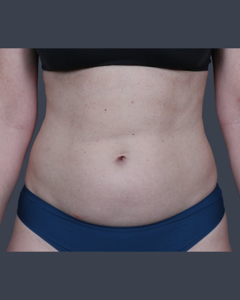 Liposuction Before & After Gallery - Patient 375191 - Image 1