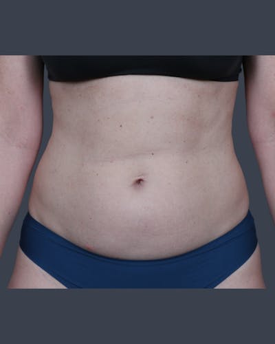 Liposuction Before & After Gallery - Patient 375191 - Image 1