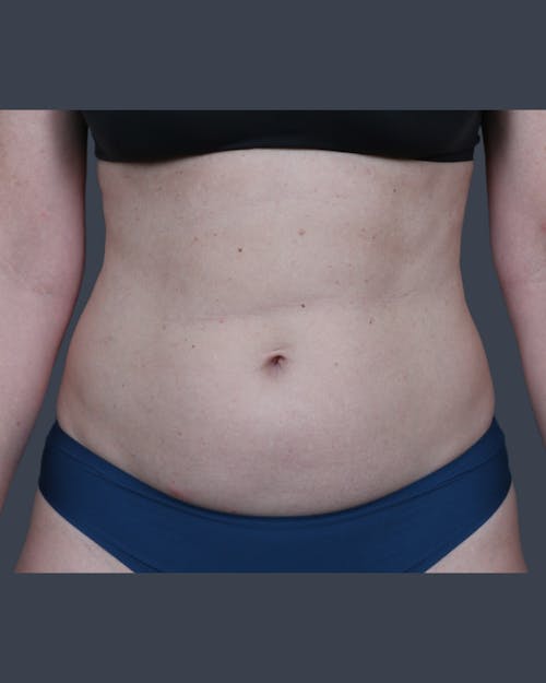 Before procedure image for Liposuction