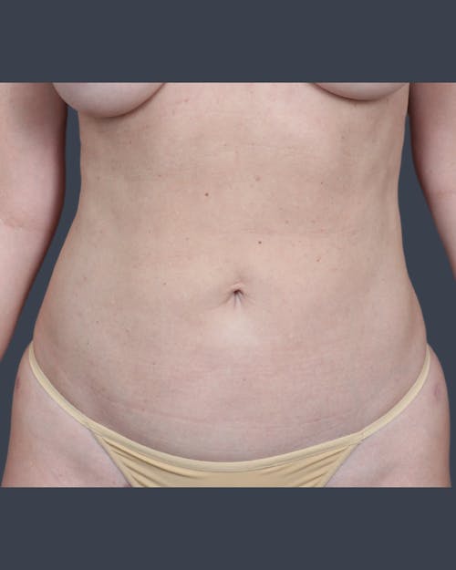 After procedure image for Liposuction