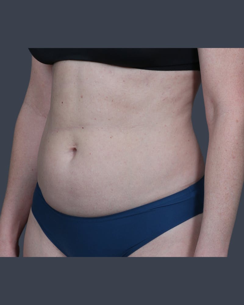 Liposuction Before & After Gallery - Patient 375191 - Image 3