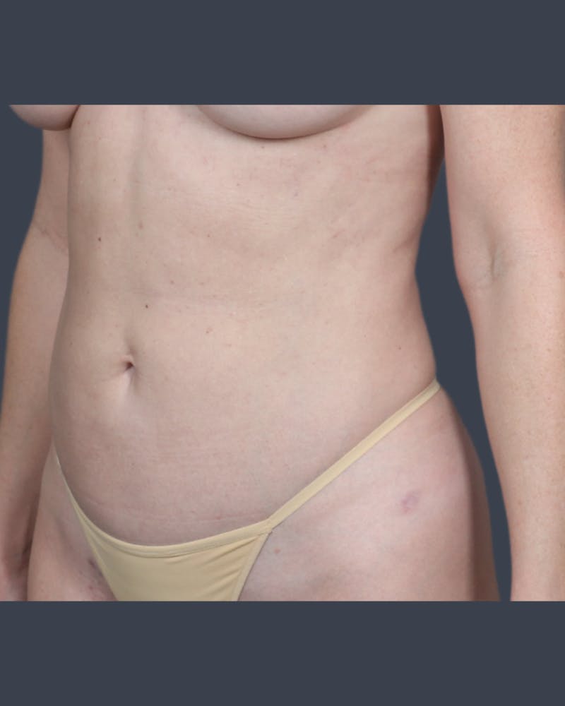 Liposuction Before & After Gallery - Patient 375191 - Image 4
