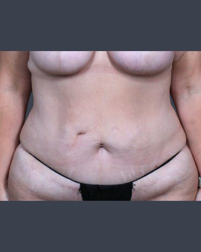 Abdominoplasty / Tummy Tuck Before & After Gallery - Patient 223807 - Image 1