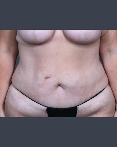 Before procedure image for Abdominoplasty / Tummy Tuck