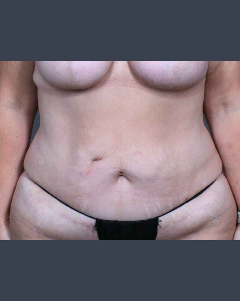 Abdominoplasty / Tummy Tuck Before & After Gallery - Patient 223807 - Image 1
