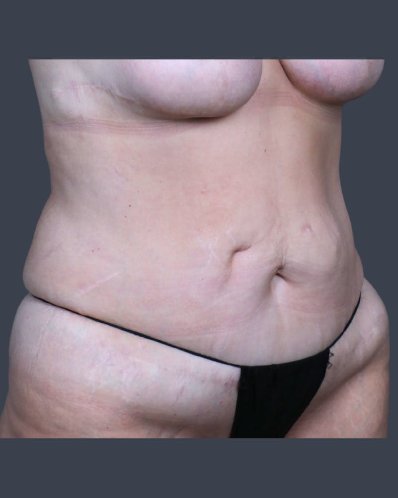 Abdominoplasty / Tummy Tuck Before & After Gallery - Patient 223807 - Image 3