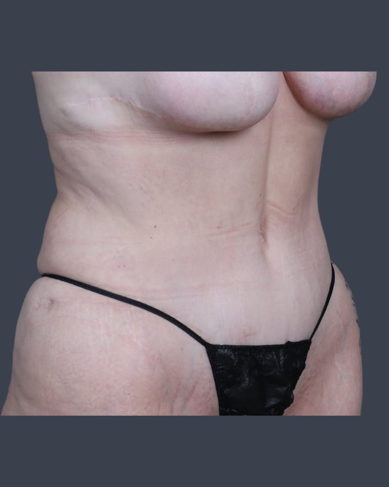 Abdominoplasty / Tummy Tuck Before & After Gallery - Patient 223807 - Image 4
