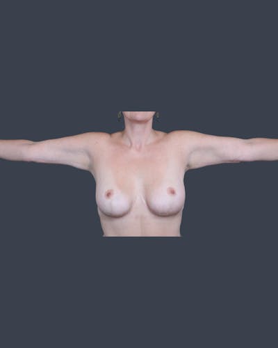 Breast Lift Before & After Gallery - Patient 113404 - Image 2