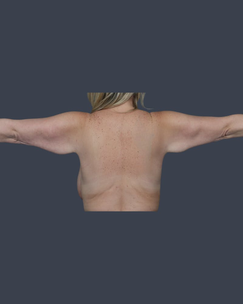 Arm Lift Before & After Gallery - Patient 338009 - Image 3