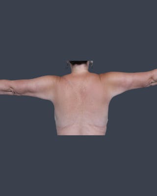 Arm Lift Before & After Gallery - Patient 338009 - Image 4