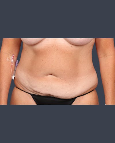Liposuction Before & After Gallery - Patient 351200 - Image 1