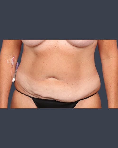 Before procedure image for Abdominoplasty / Tummy Tuck