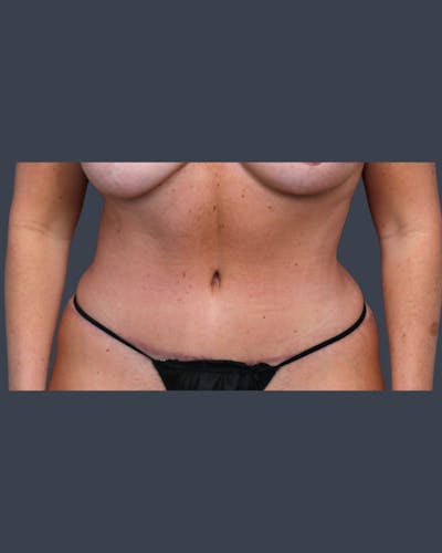 Abdominoplasty / Tummy Tuck Before & After Gallery - Patient 237625 - Image 2