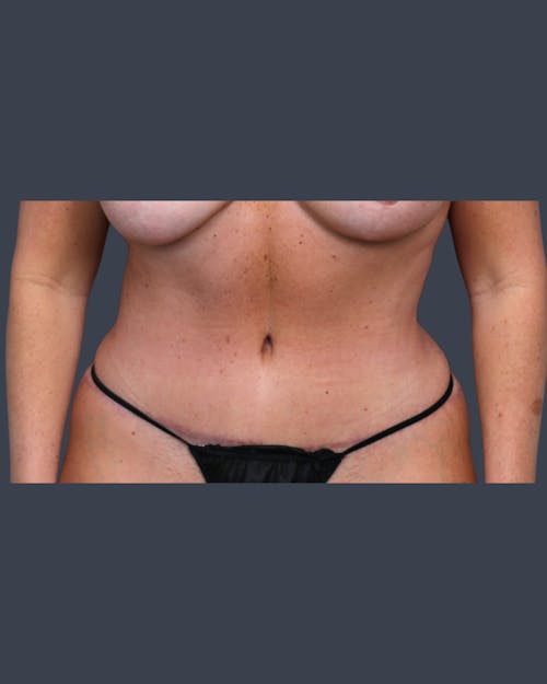 After procedure image for Abdominoplasty / Tummy Tuck