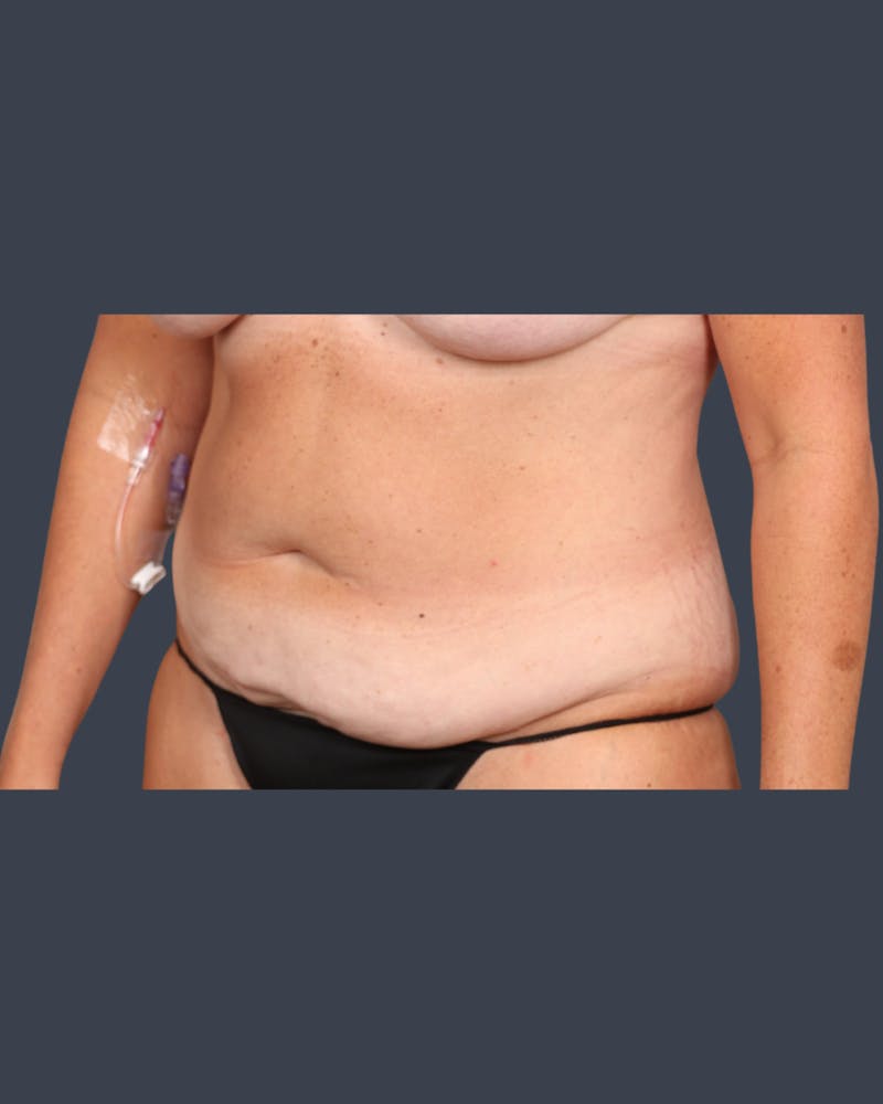 Abdominoplasty / Tummy Tuck Before & After Gallery - Patient 237625 - Image 3